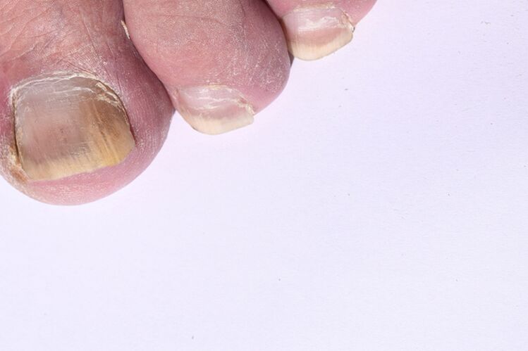počáteční fáze mykózy nehtů na nohou