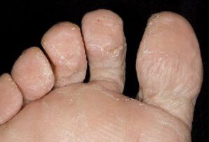 příznaky houby na kůži nohou