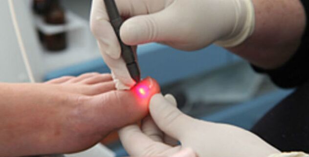 Laserová terapie plísní nehtů na nohou