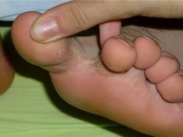 houba mezi prsty na nohou