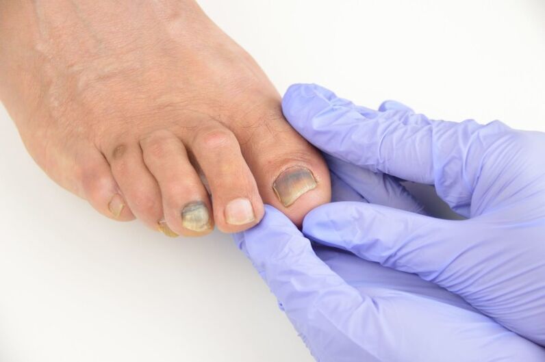 Lékařské vyšetření nehtů na nohou postižených plísní