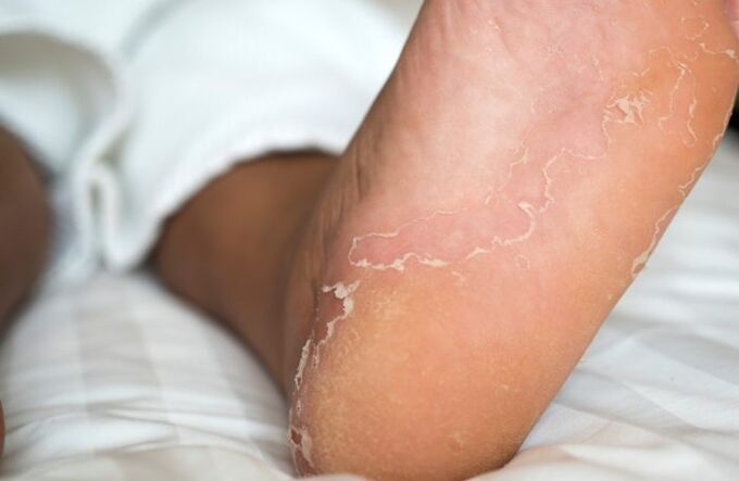 infekce nohou s plísní nehtů