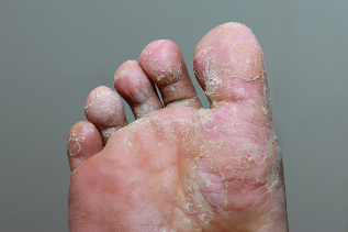 Těžká fáze mykóza kůže prstů na nohou